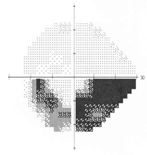 Study Identifies Visual Field Defects Common in Subtypes